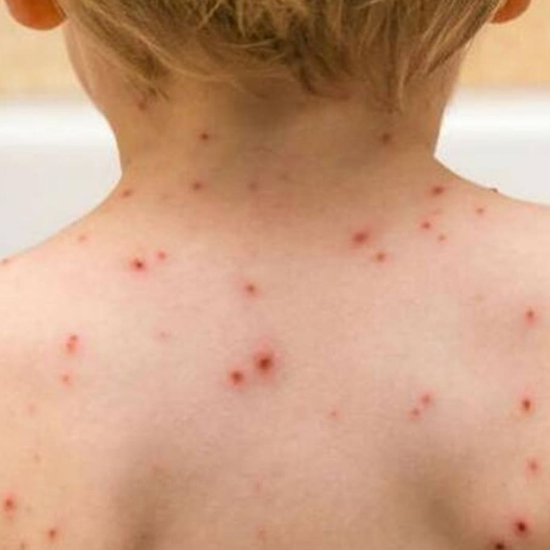 What Parents Should Know About Monkeypox? in Andheri Juhu, Vile parle Mumbai What Parents Should Know About Monkeypox? in Jogeshwari, Andheri Mumbai
